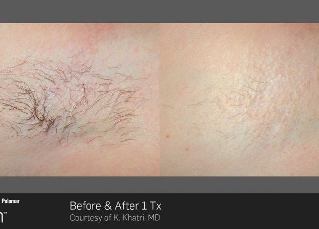 bloom-Hair-Removal-Before-&-After-4