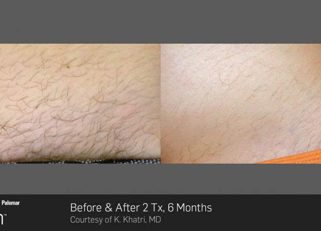 bloom-Hair-Removal-Before-&-After-Photo-7
