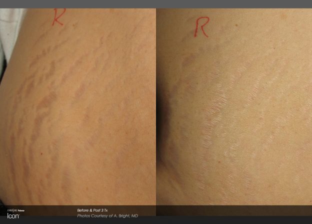 bloom-Stretch-Mark-Before-&-After-2