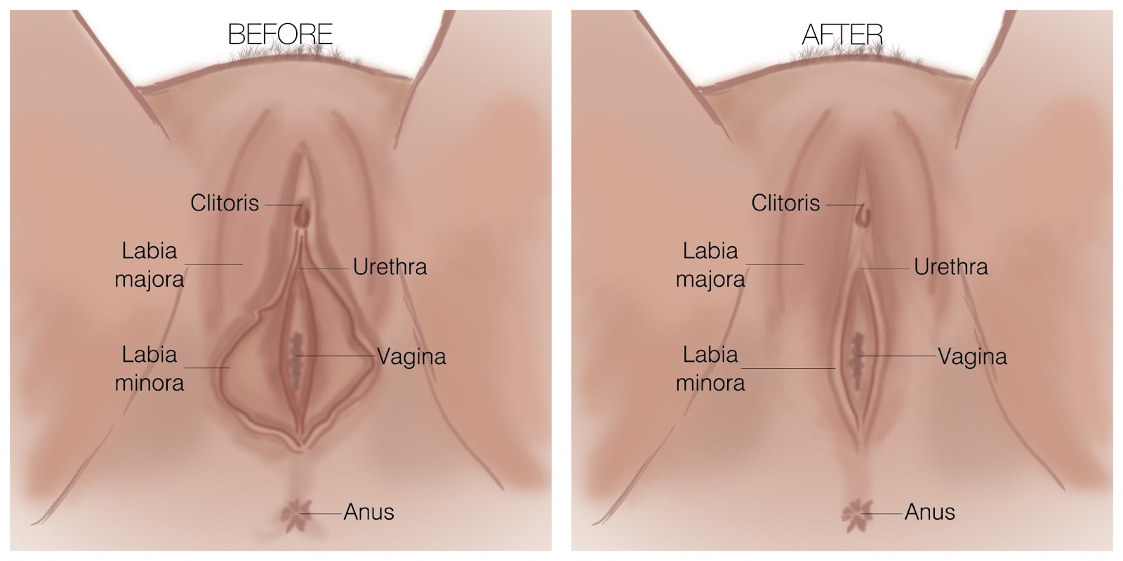 Labiaplasty educational diagram
