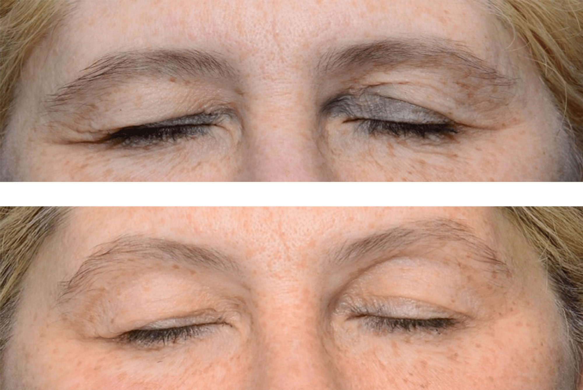ThermiSmooth radiofrequency skin tightening treatment