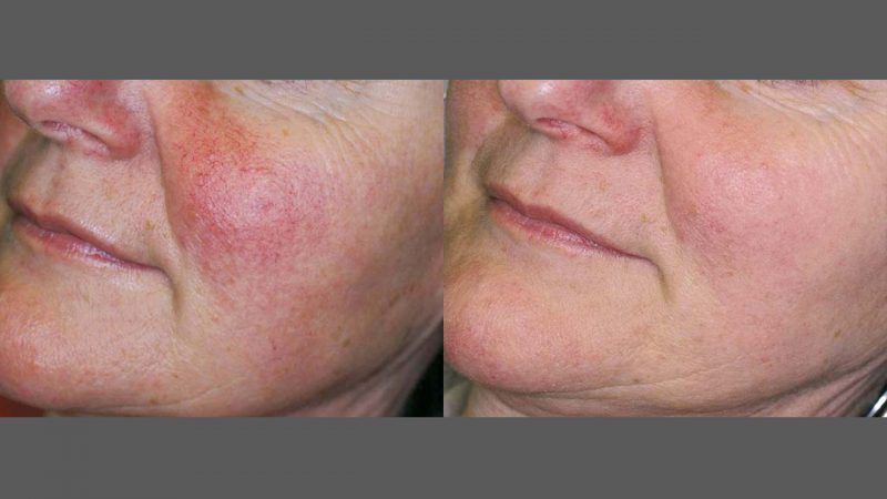 IPL photorejuvenation before and after results at Bloom OB/GYN