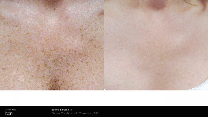 IPL photorejuvenation before and after results at Bloom OB/GYN