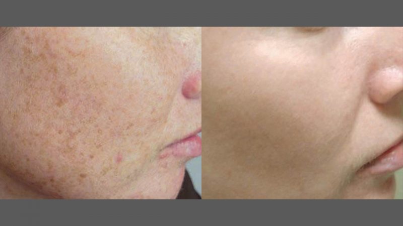 IPL photorejuvenation before and after results at Bloom OB/GYN
