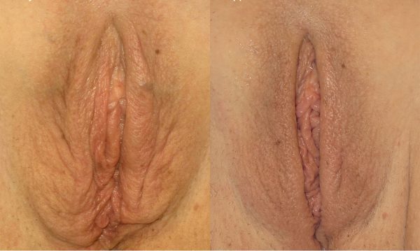 ThermiVa vaginal rejuvenation treatment at Bloom OB/GYN