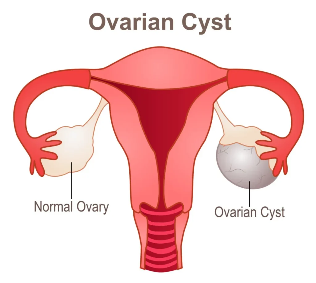 Ovarian cyst and cystectomy information at Bloom OB/GYN