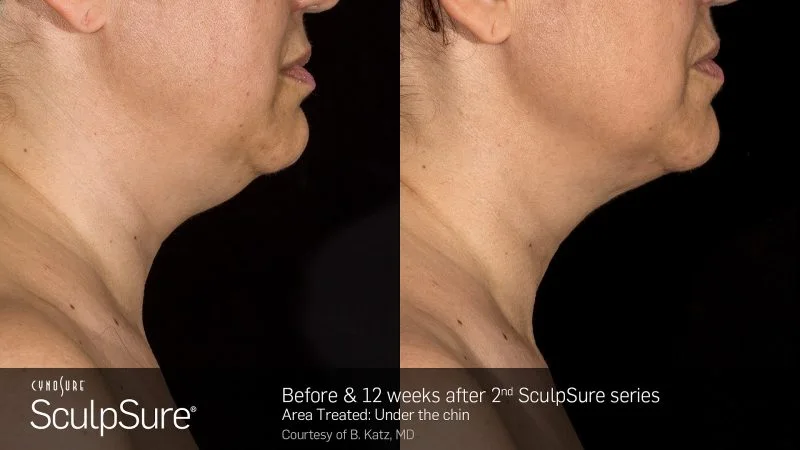 SculpSure submental contouring results at Bloom OB/GYN